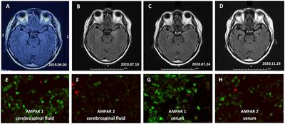 Recurrent Anti-AMPA Receptor Limbic Encephalitis: A Case Report and Literature Review